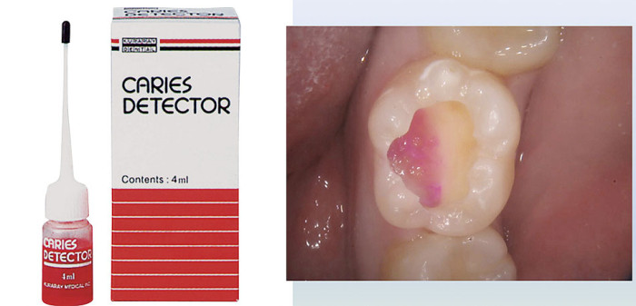 赤く染まったところが虫歯、これは世界中で使われている虫歯認定液